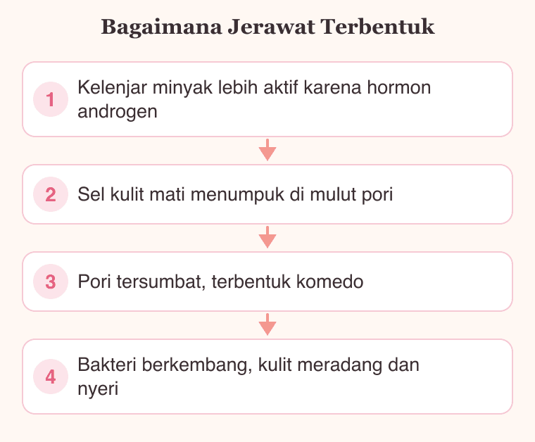 Diagram empat tahap terbentuknya jerawat mulai dari produksi minyak berlebih sampai peradangan